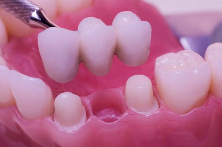 Принципы препарирования («обточки») зуба под керамику