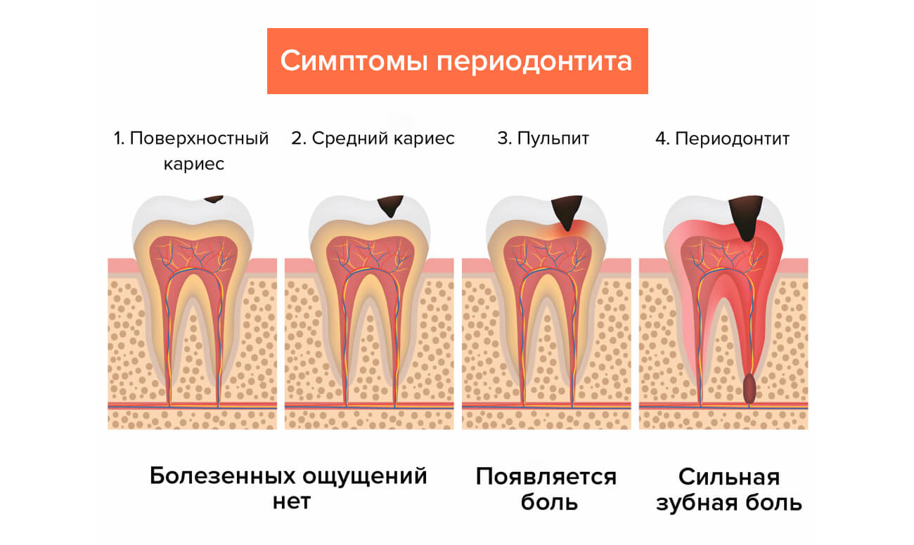 Пульпит кариес зубов периодонтит