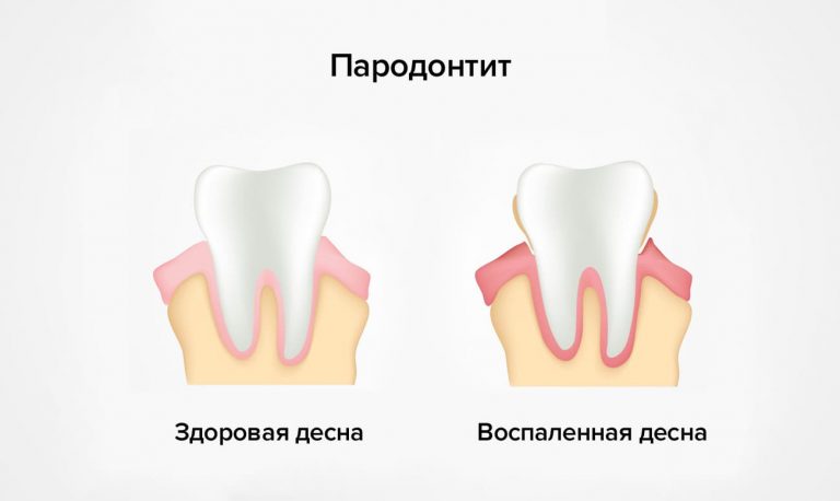 Пародонтит и гингивит презентация