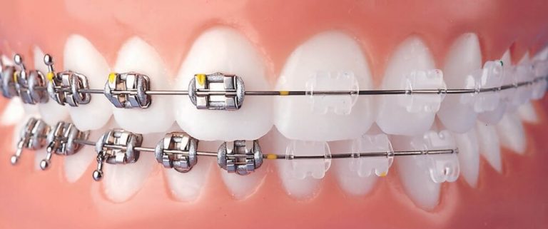 Как избежать развития кариеса во время ортодонтического лечения?
