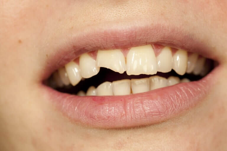 Скол зуба – что делать?
