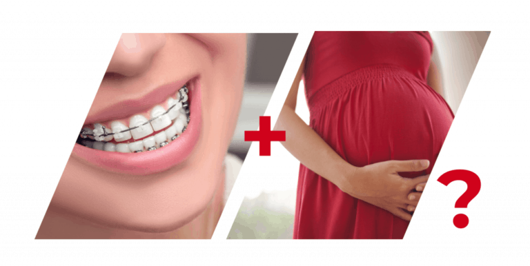 Можно ли носить брекеты беременным?