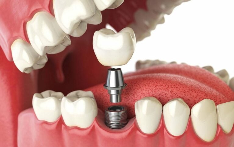 Отторжение зубных имплантов