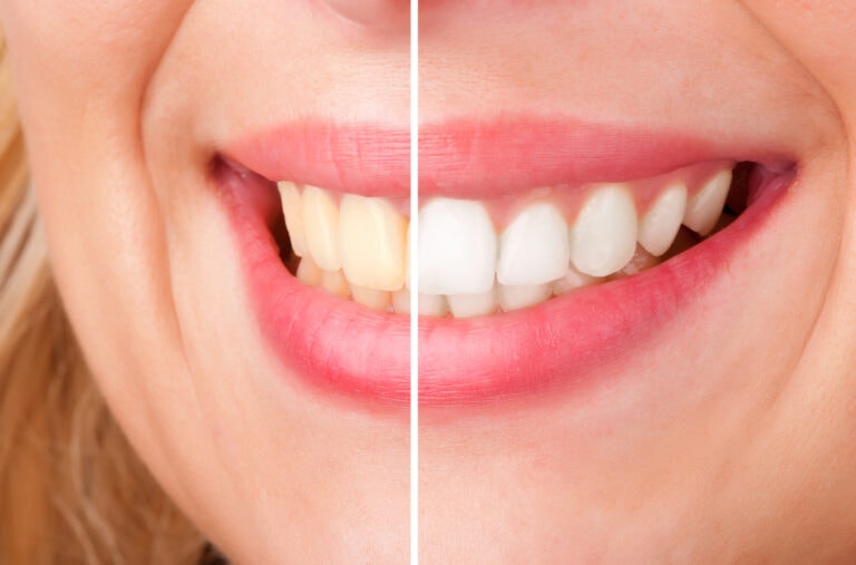 Сравнение существующих методов отбеливания зубов
