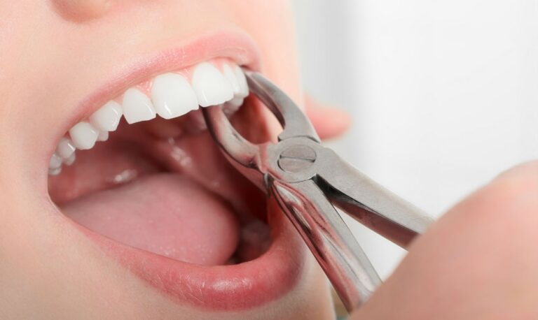 Рекомендации после удаления зуба