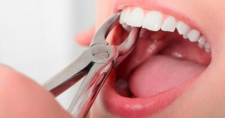 Осложнения после удаления зуба: когда обращаться за помощью
