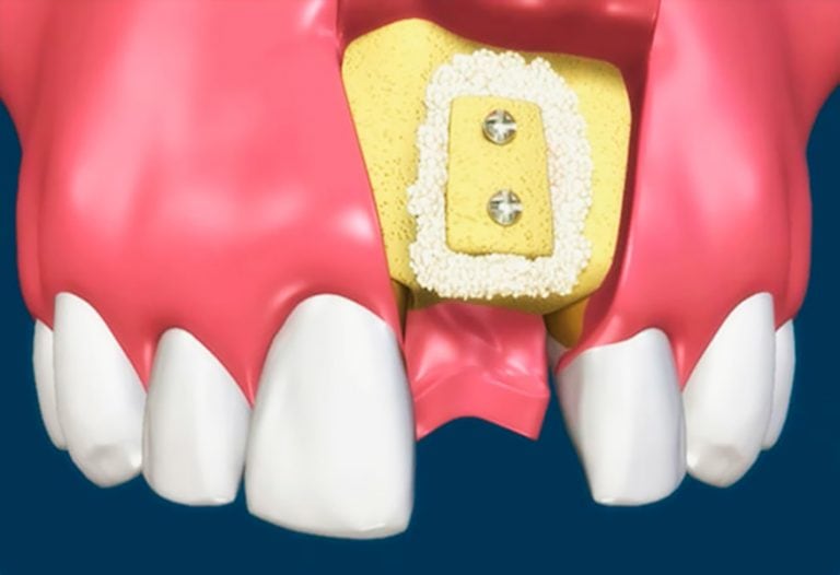 Костная пластика для имплантации зубов