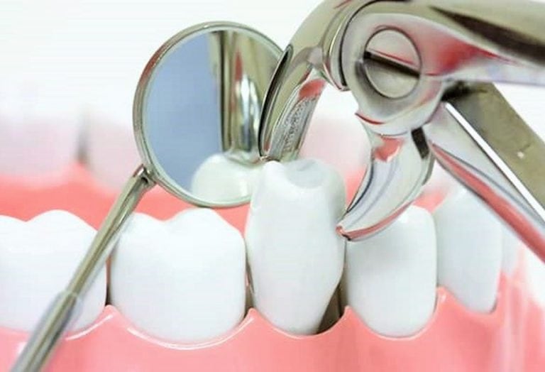 Когда зуб нельзя спасти: удаление зубов