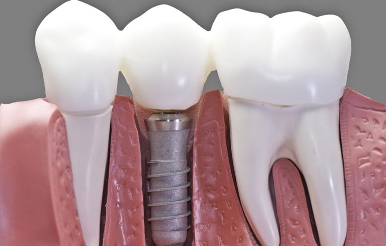 Удаление зубного импланта