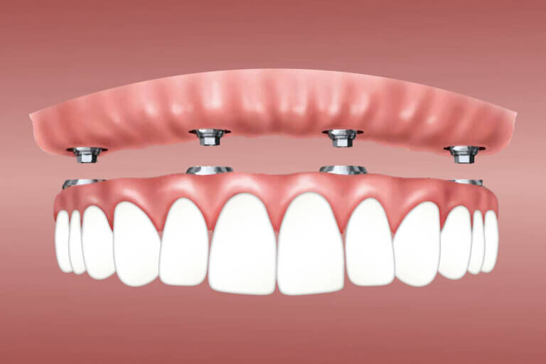 Тотальное протезирование в стоматологии