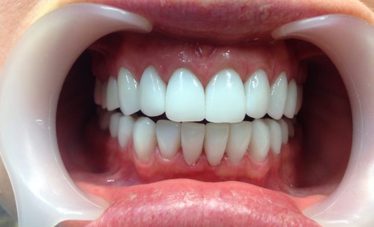 Можно ли не удалять нервы при протезировании? Стандарты немецкой стоматологии